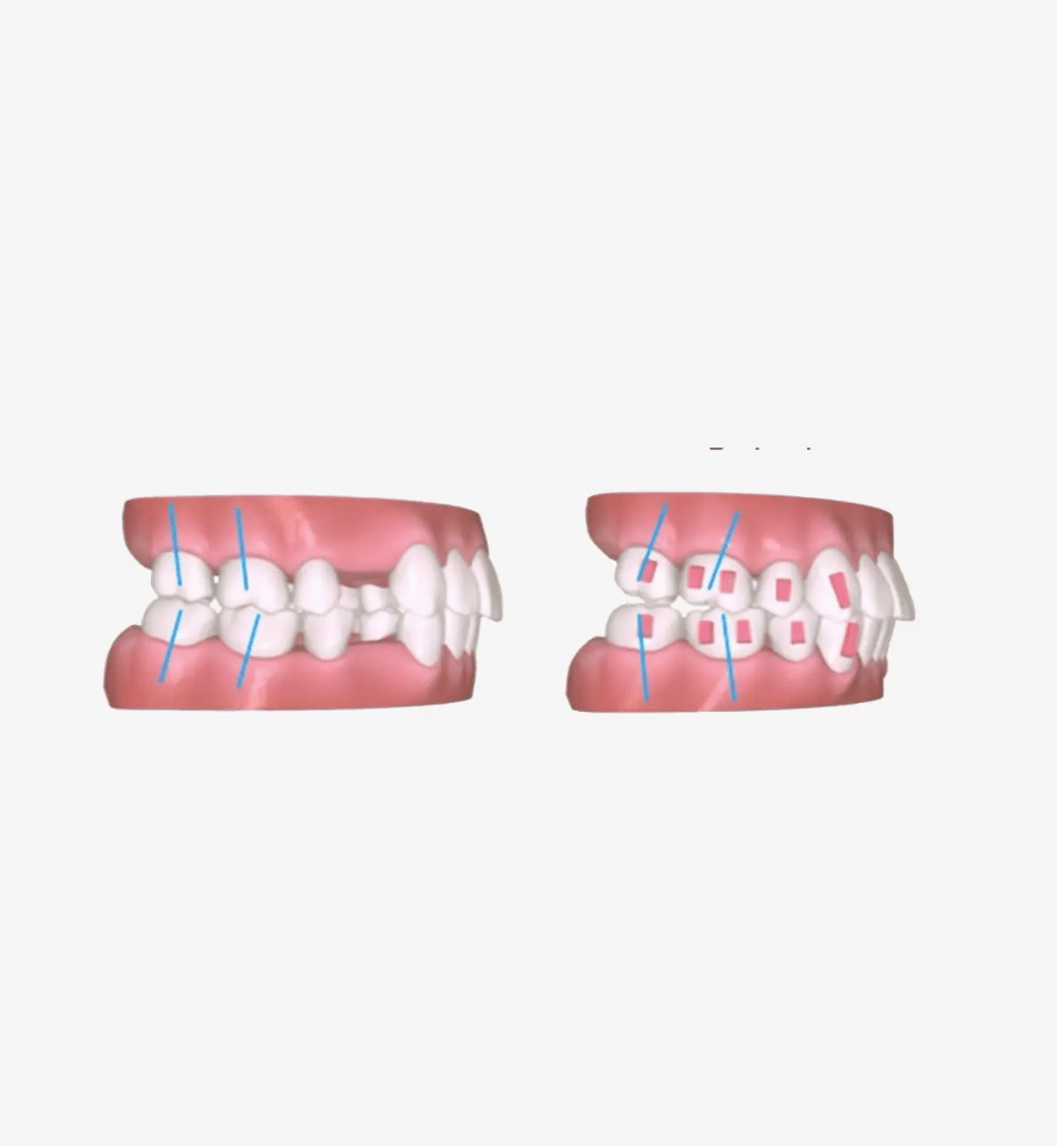 Angel Aligner Technology - A7 Premolar Extraction - Angel Aligner Singapore