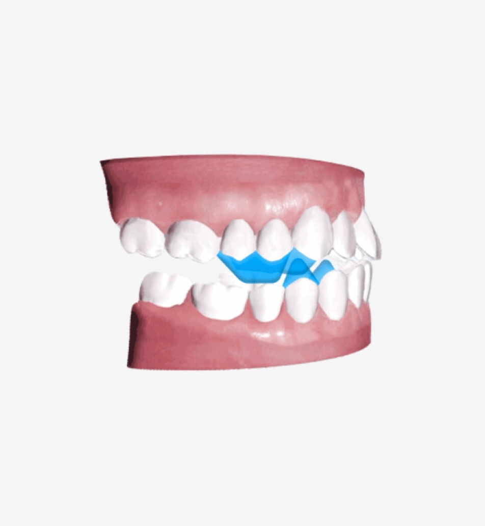 Angel Aligner Technology - A6 Mandibular Advancement - Angel Aligner Singapore