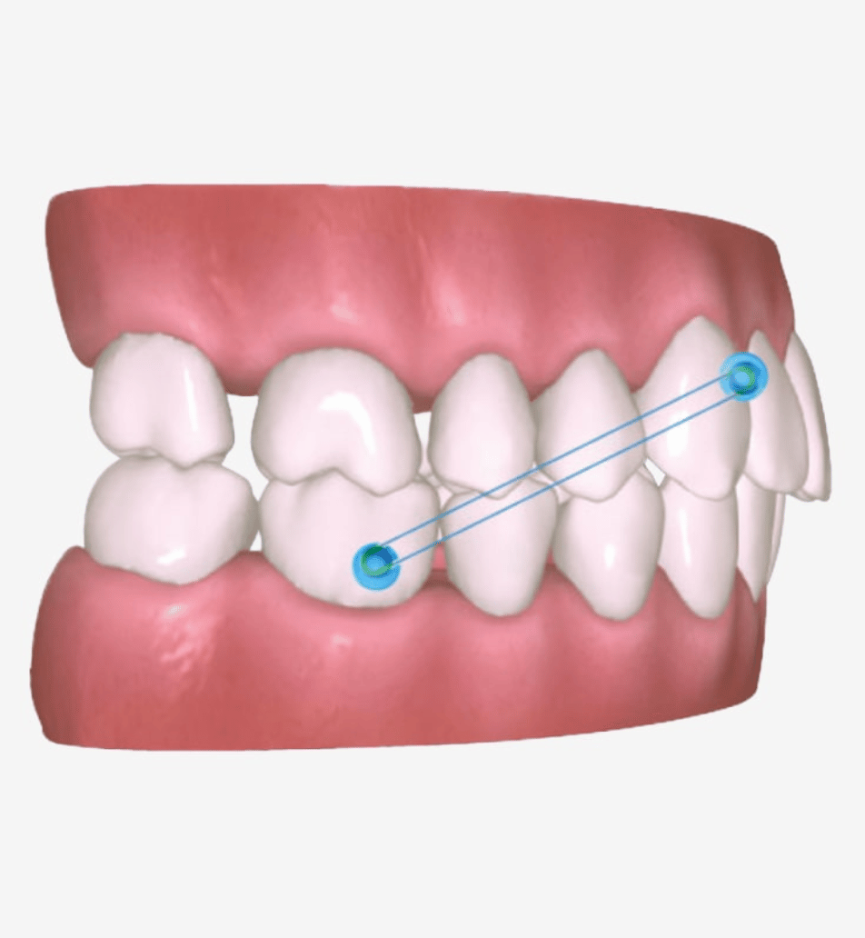 Angel Aligner Technology - Molar Distalization - Angel Aligner Singapore